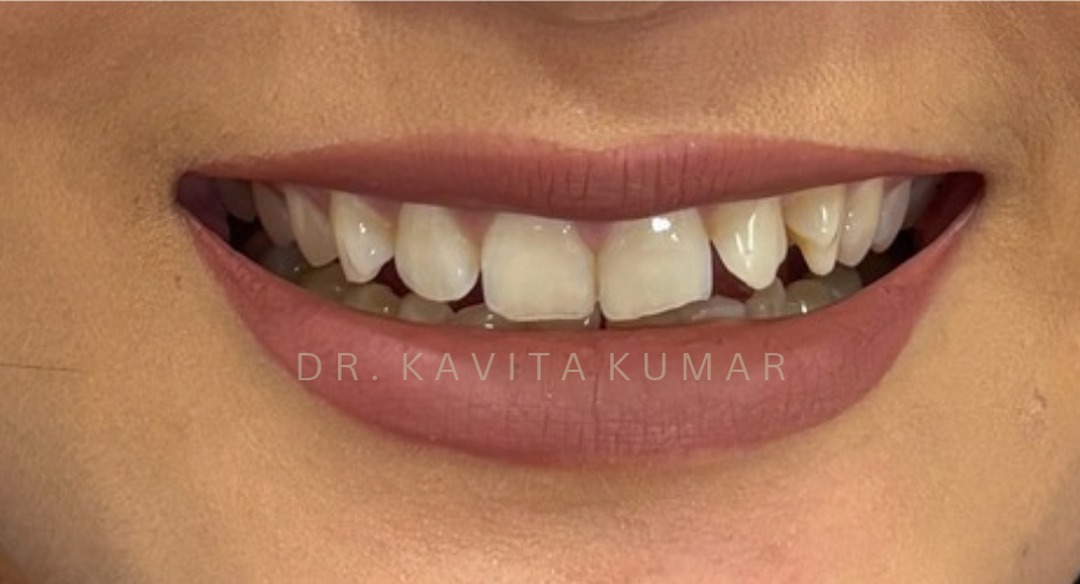 Before: Veneers
