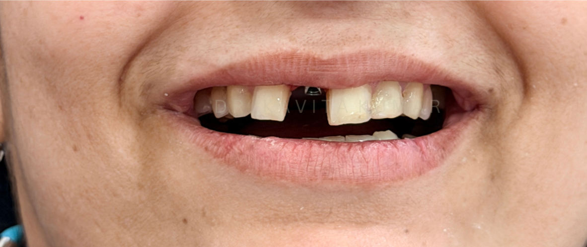 Before treatment