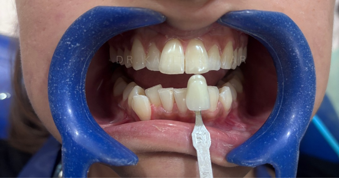 After: Office Teeth Whitening
