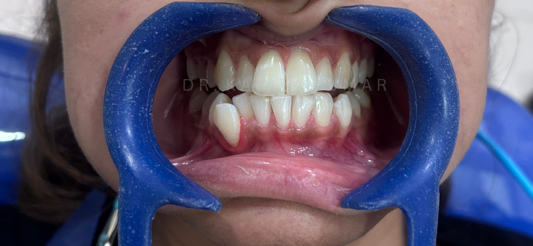 After: Office Teeth Whitening