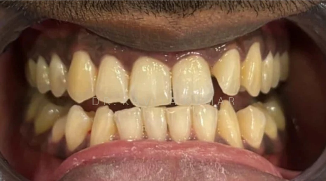 Before: Zoom! Teeth Whitening