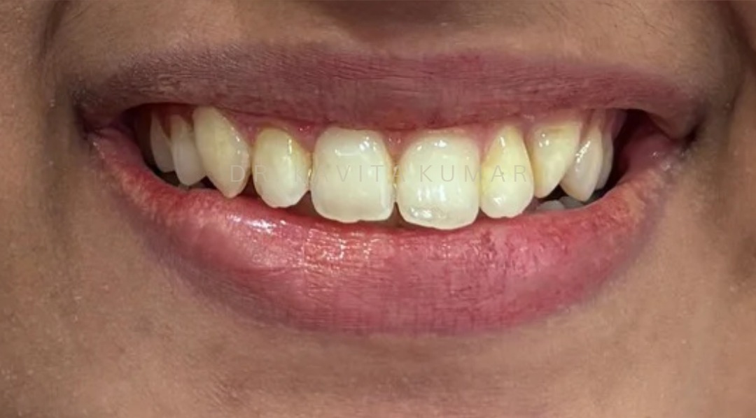 After: Composite Bonding