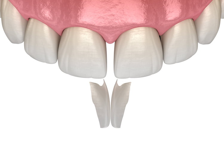 Composite Bonding