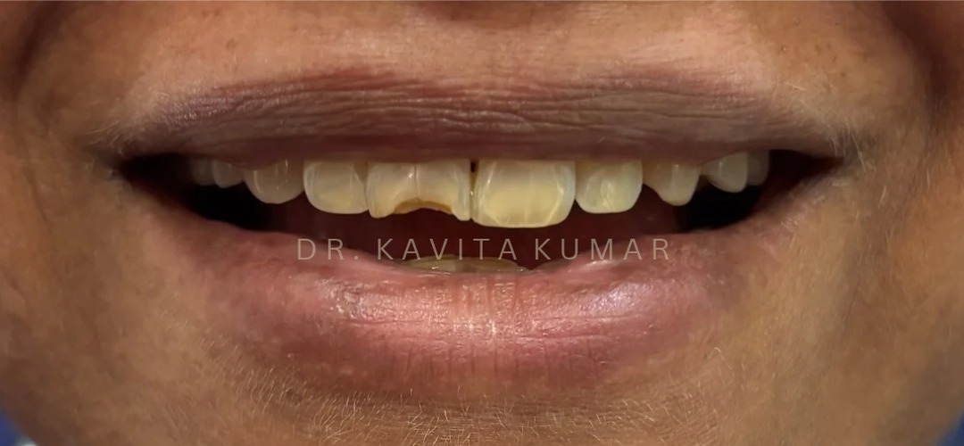 Before: Veneers