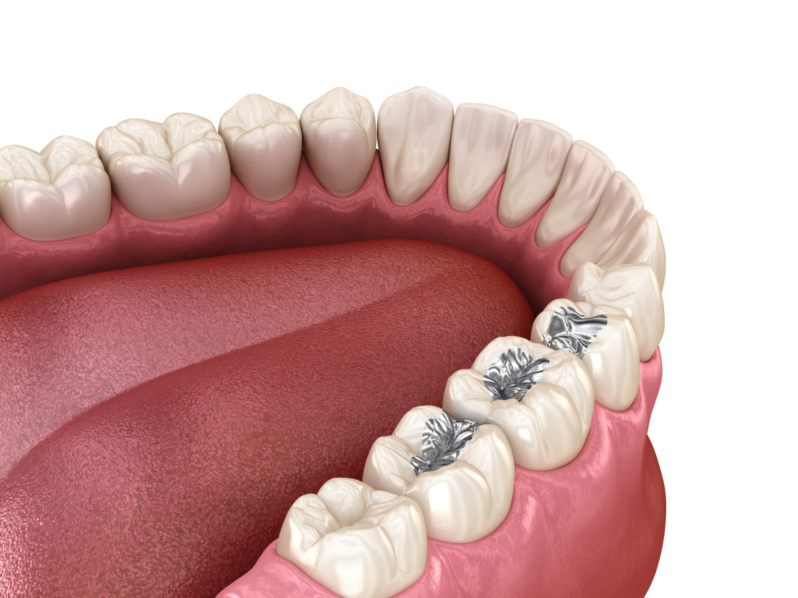 Preventive Sealants — Preventive & General Dentistry
