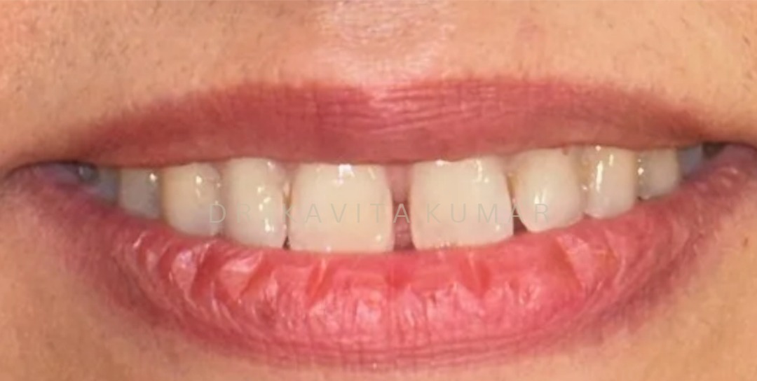 Before: Composite Bonding