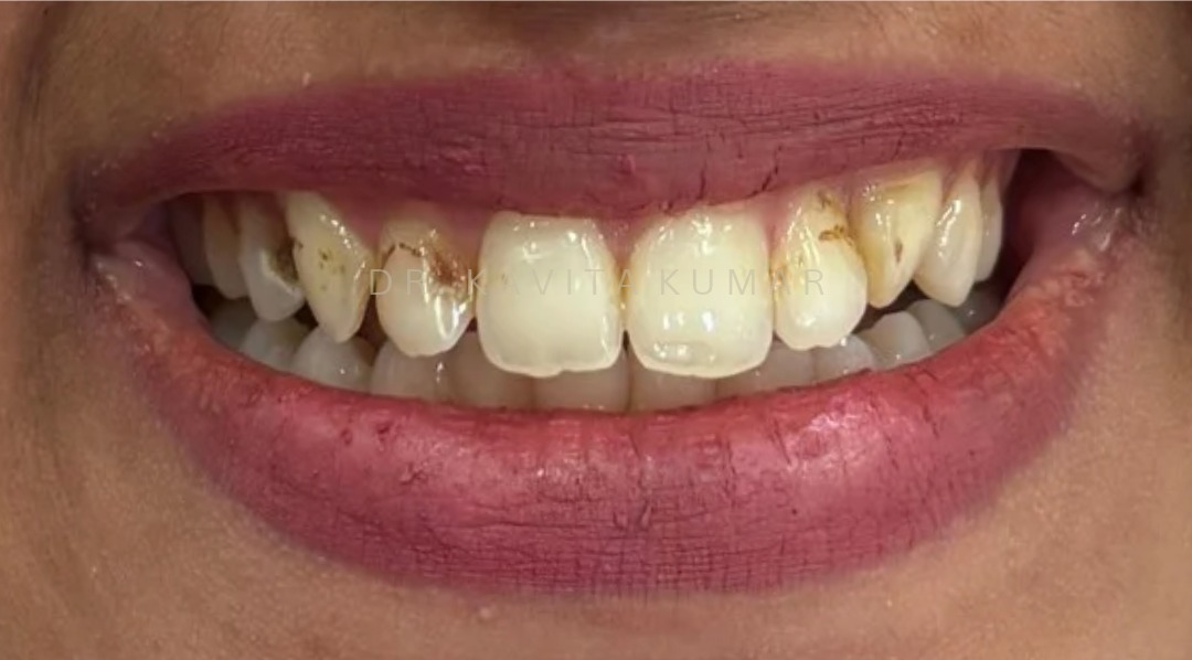 Before: Composite Bonding