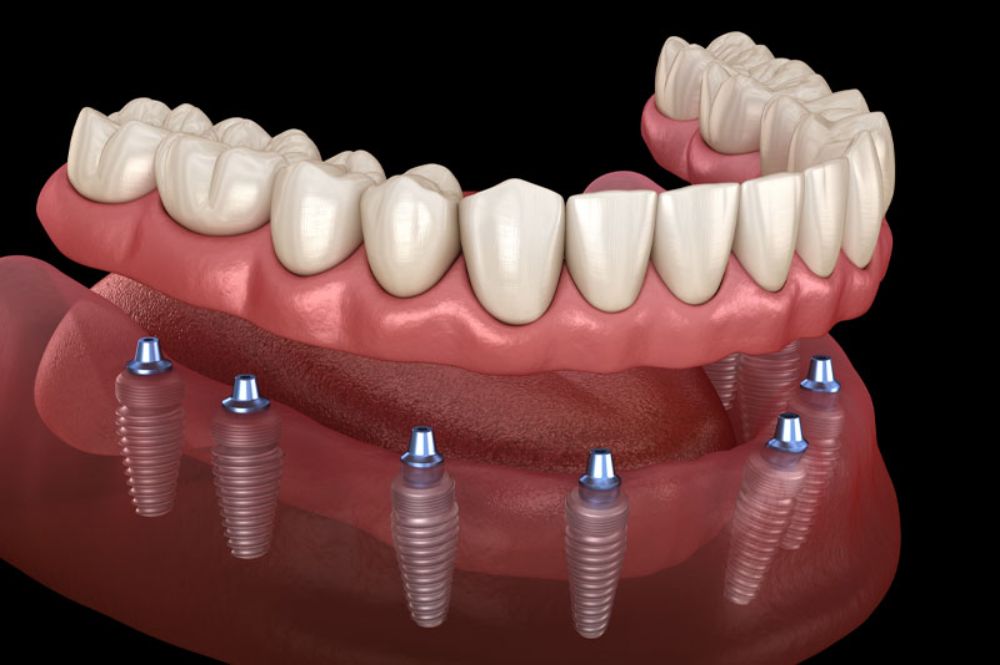 Full Mouth Rehabilitation treatment