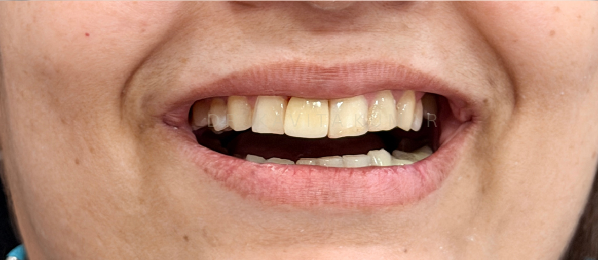 After treatment