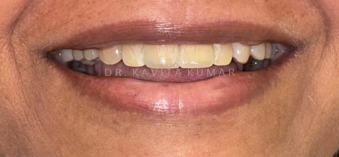 After: Veneers