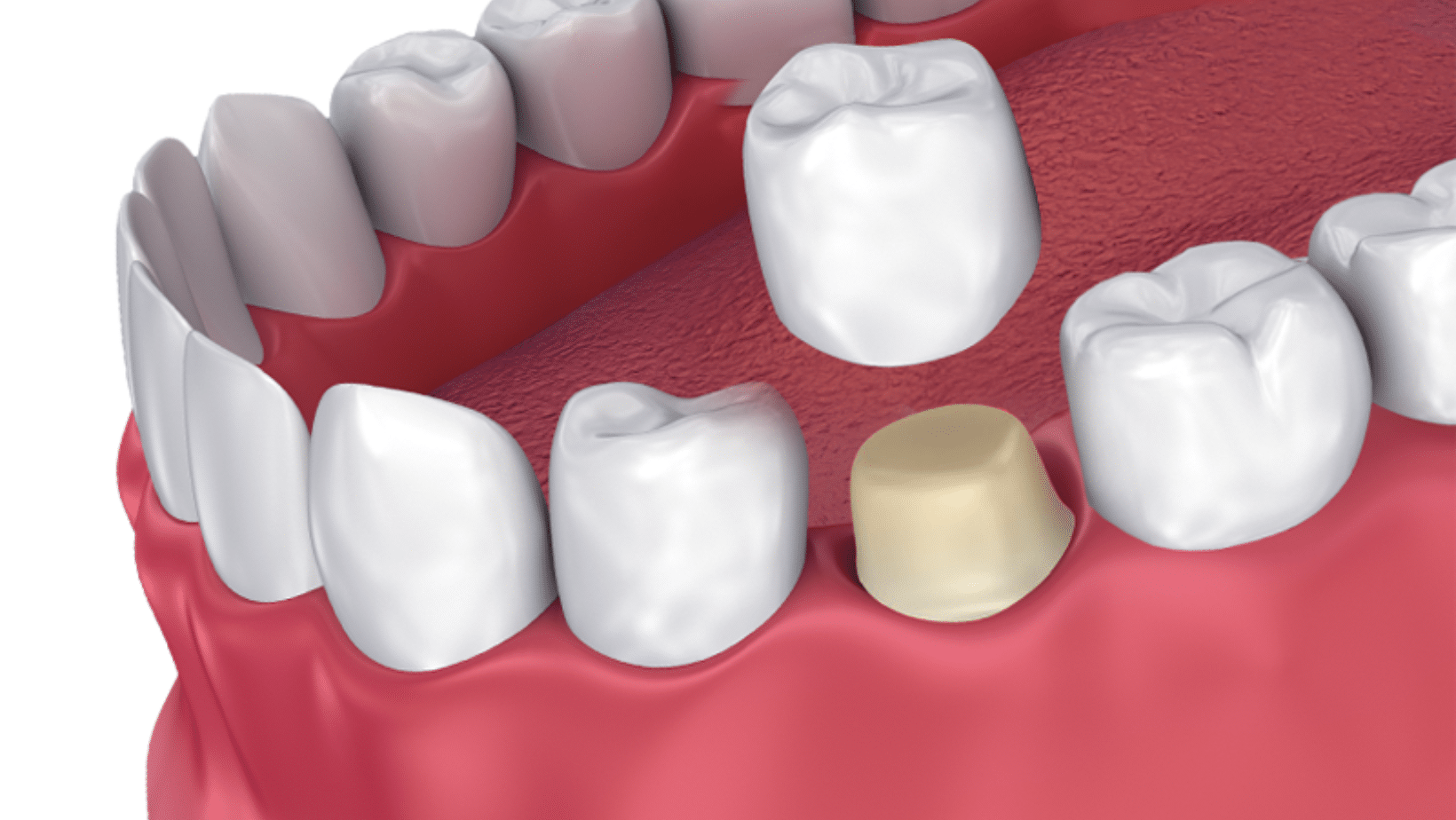Crowns & Bridges — Restorative Dentistry