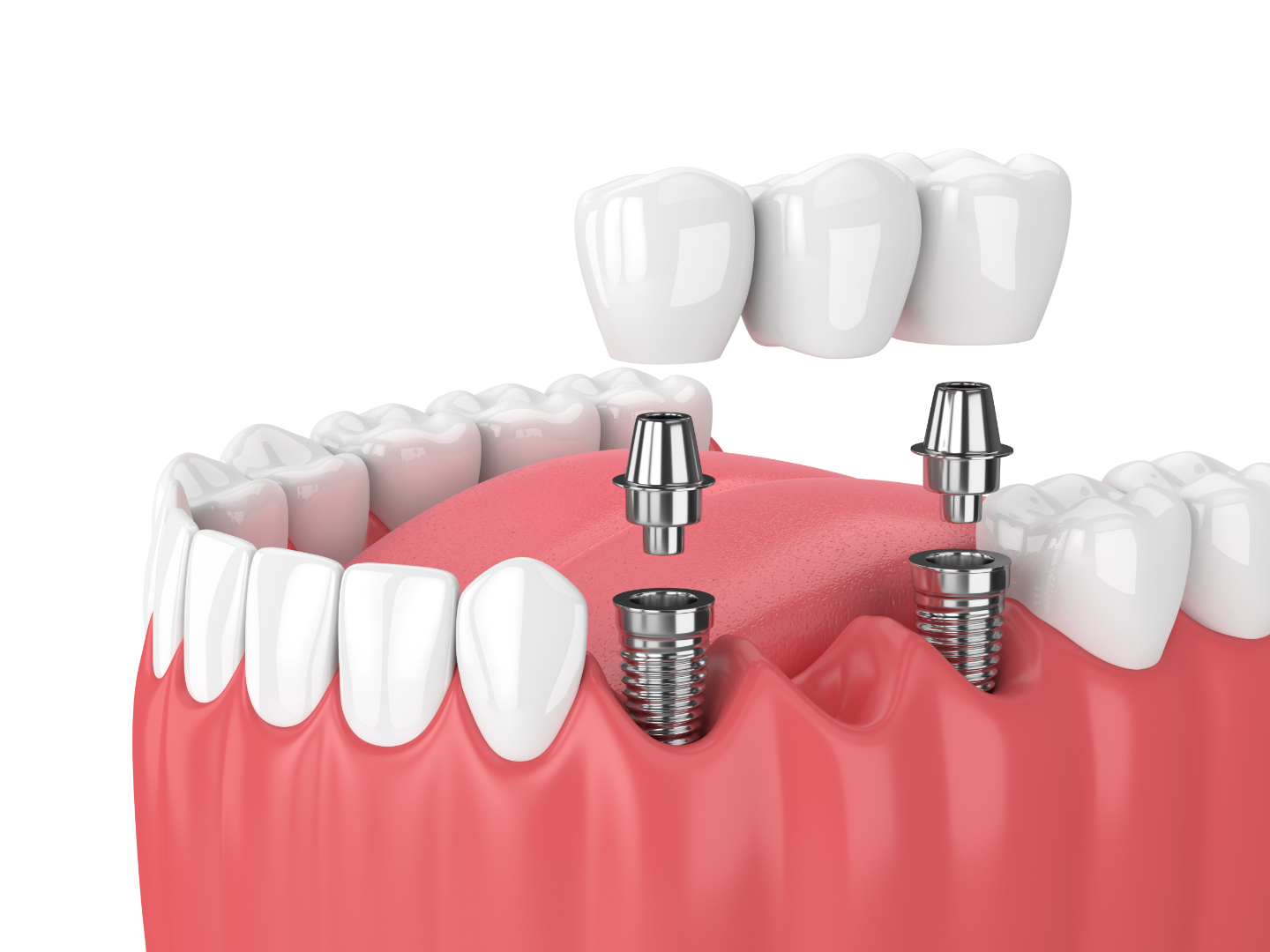 Dental Implants treatment