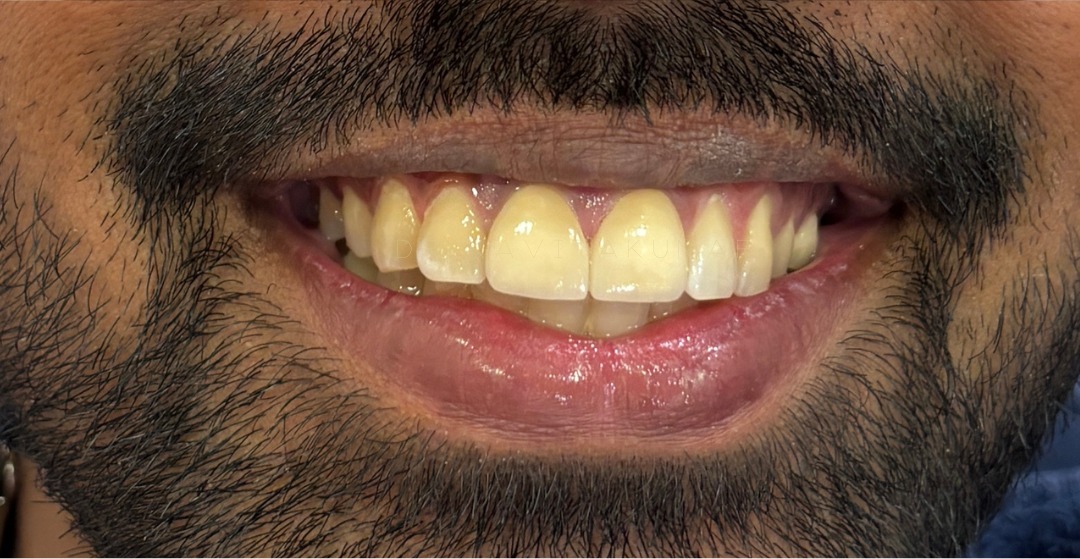 After: Veneers