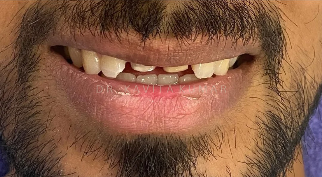 Before: Anterior Zirconia Crowns