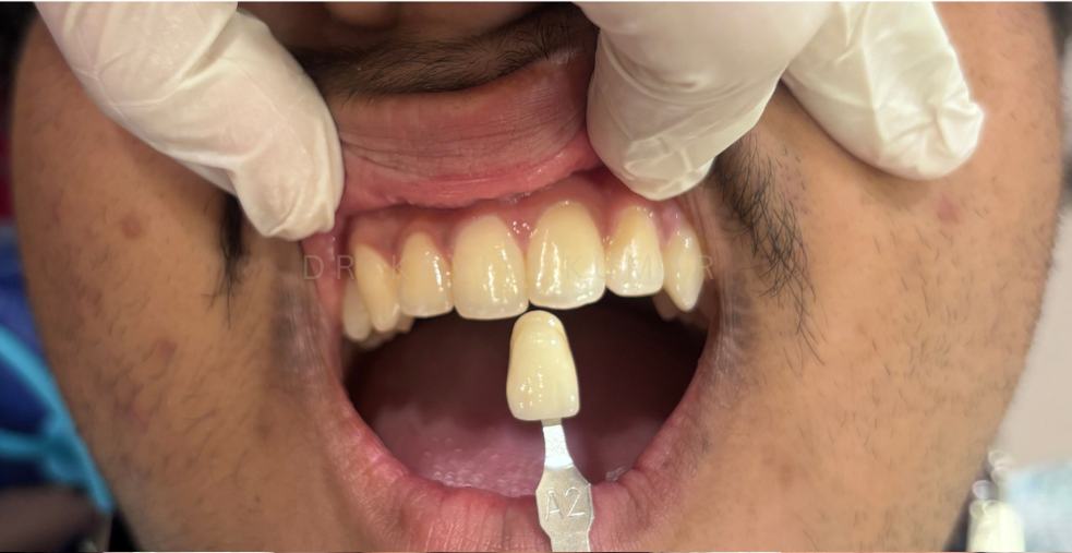 Before treatment