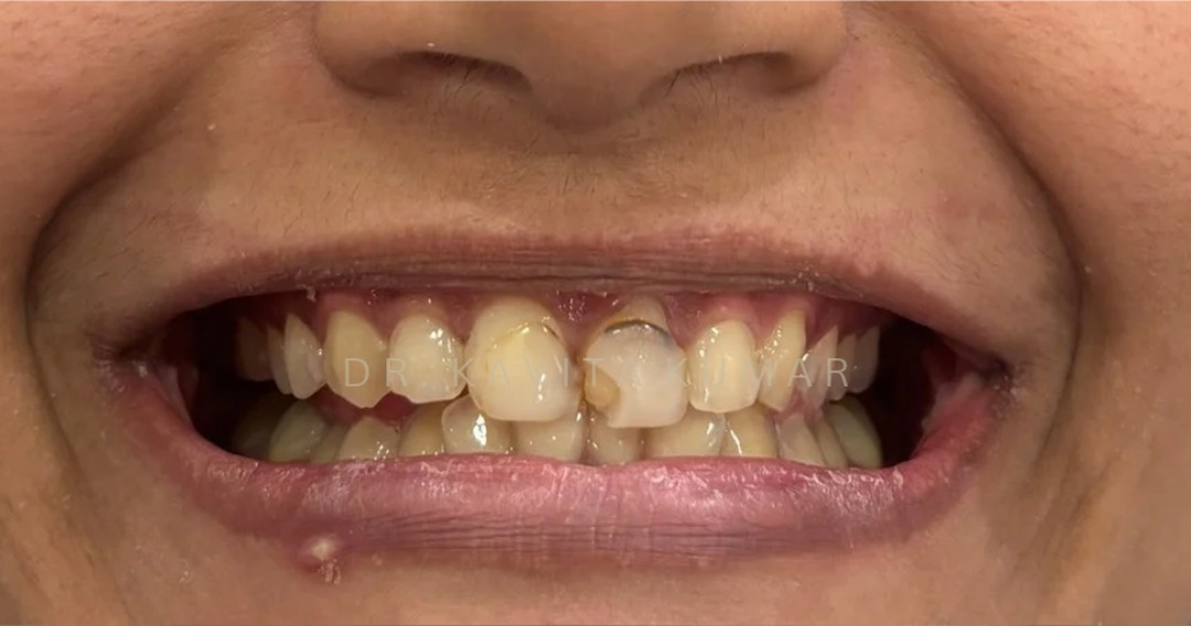 Before: Composite Bonding