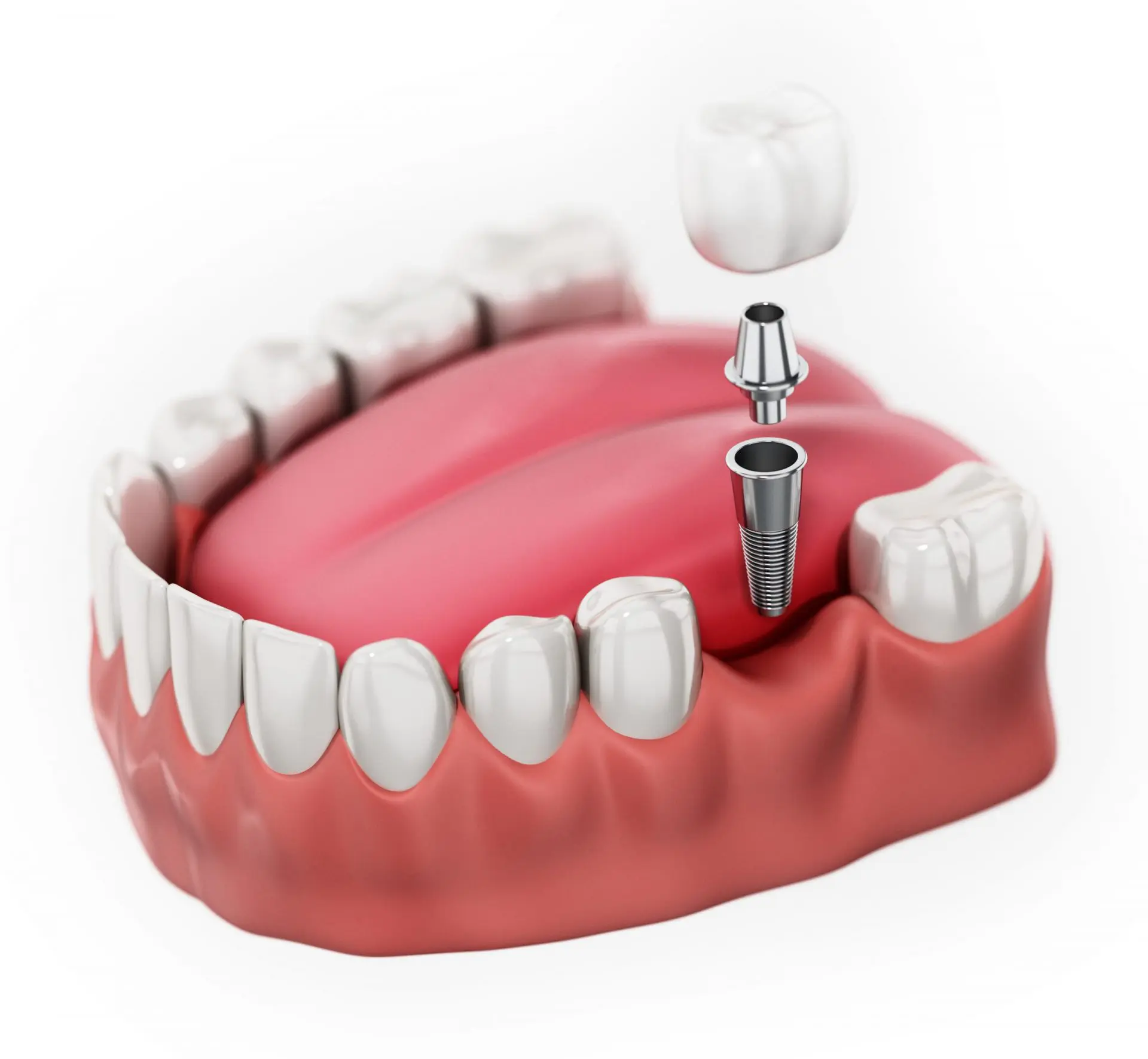 Single-Stage Implants