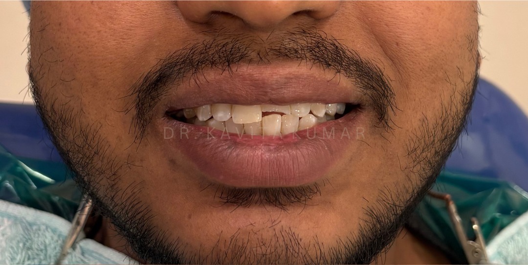 Before: Anterior Zirconia Crowns