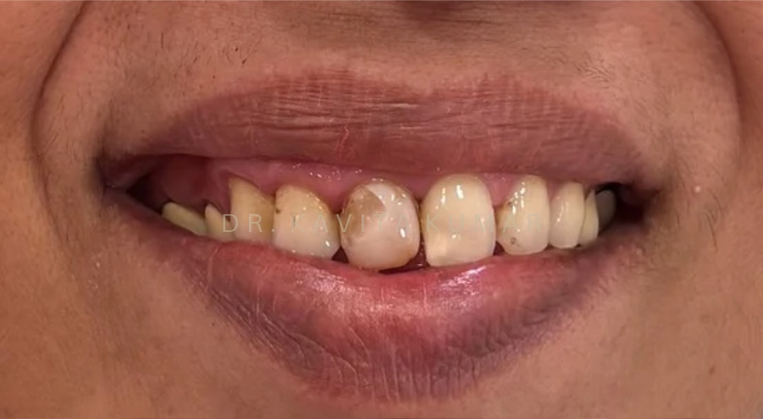 Before: Upper Anterior Veneers