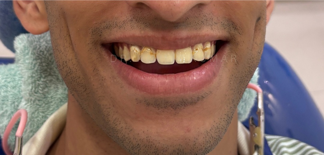 Before: Composite Bonding