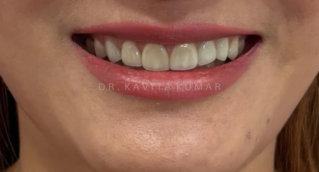 After: Veneers