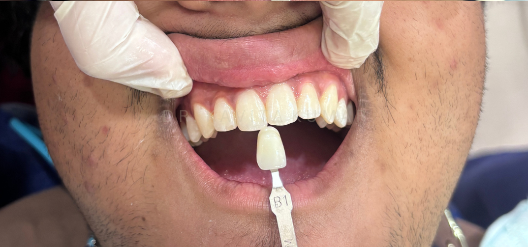 After treatment