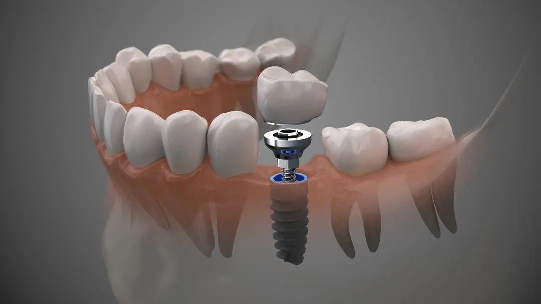 Immediate dental implant with temporary crown illustration