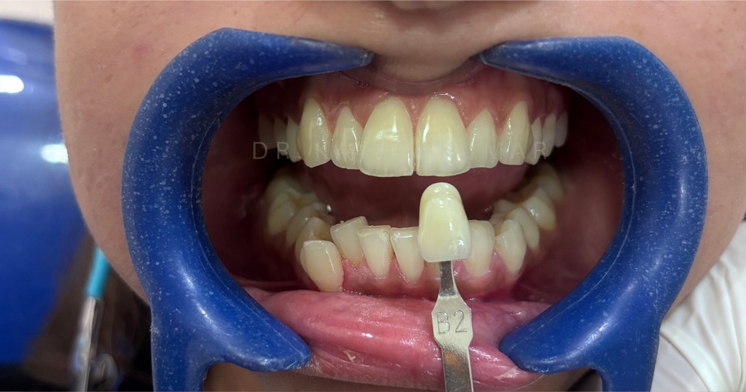 Before: Office Teeth Whitening