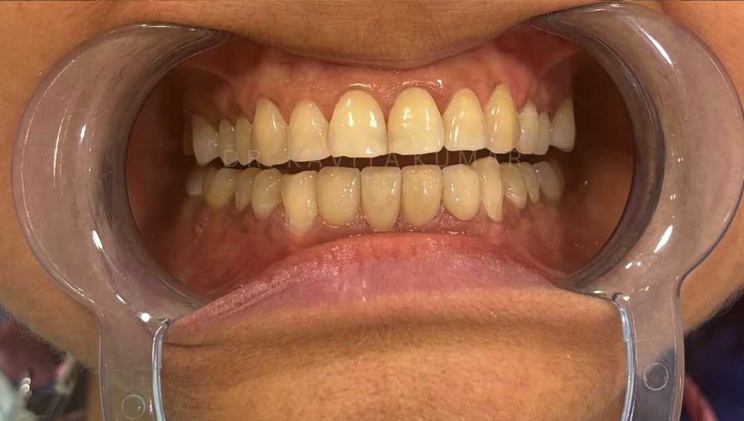 After: Veneers