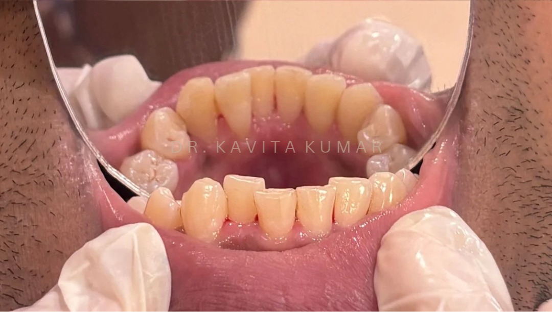 After: Professional Teeth Cleaning