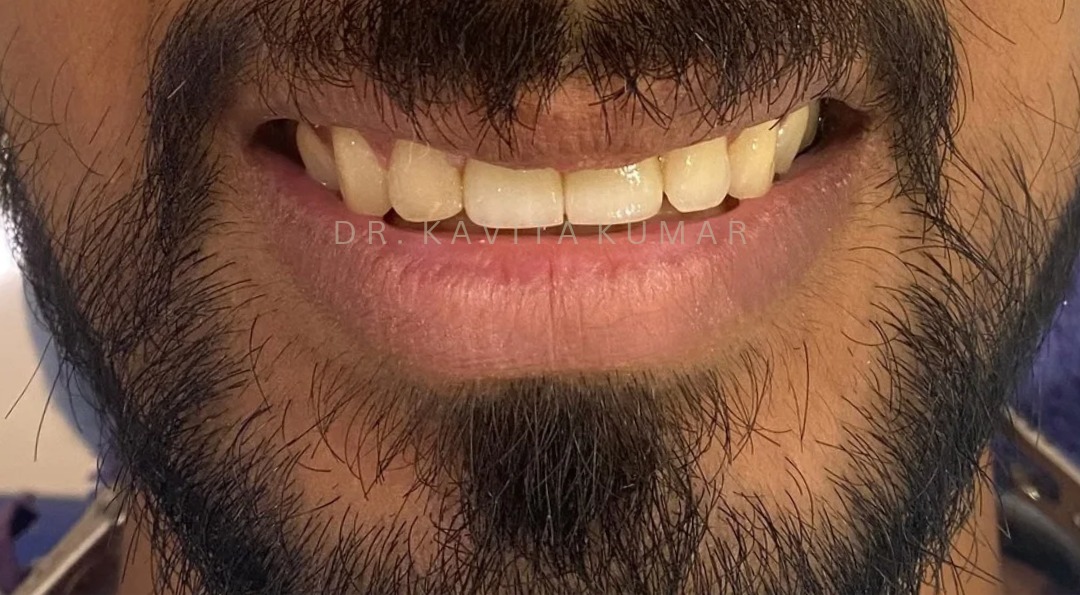 After: Anterior Zirconia Crowns