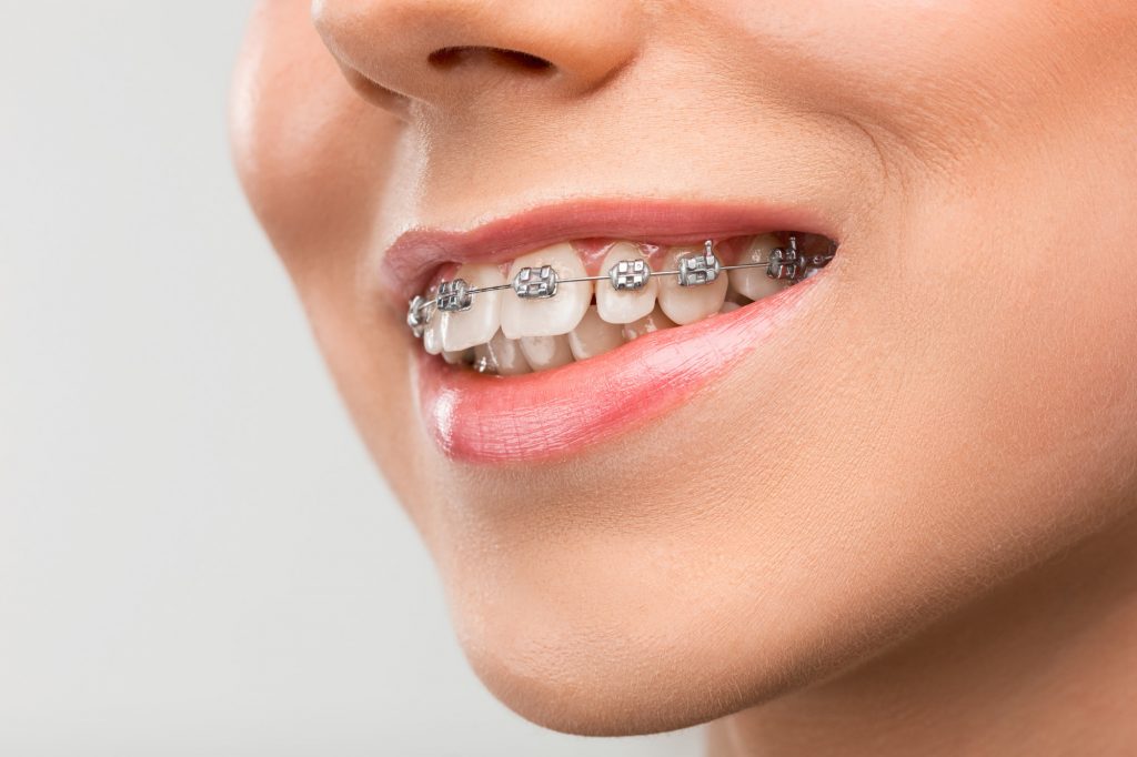 Orthodontics (Braces)
