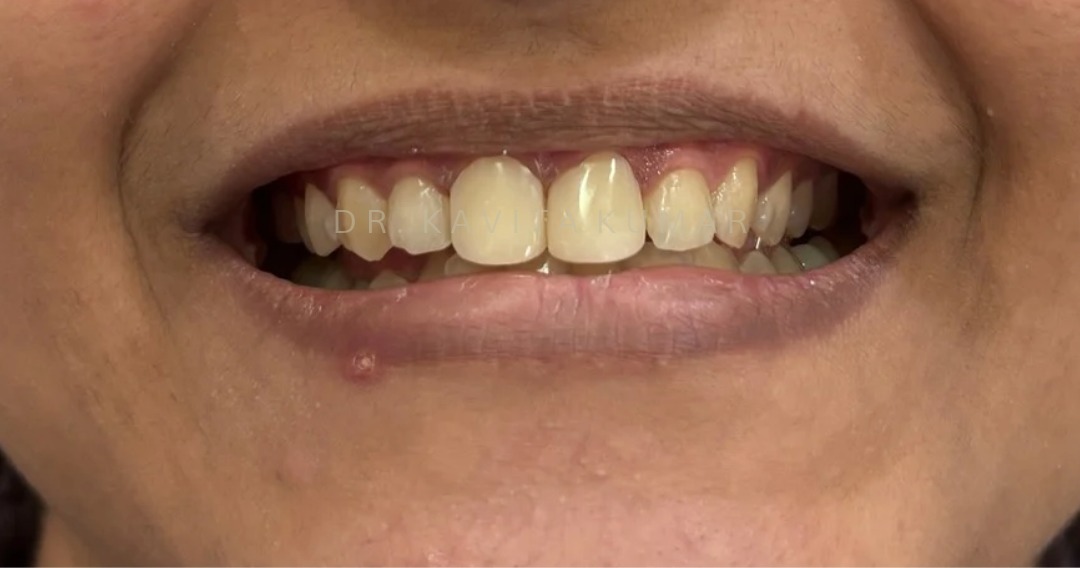 After: Composite Bonding