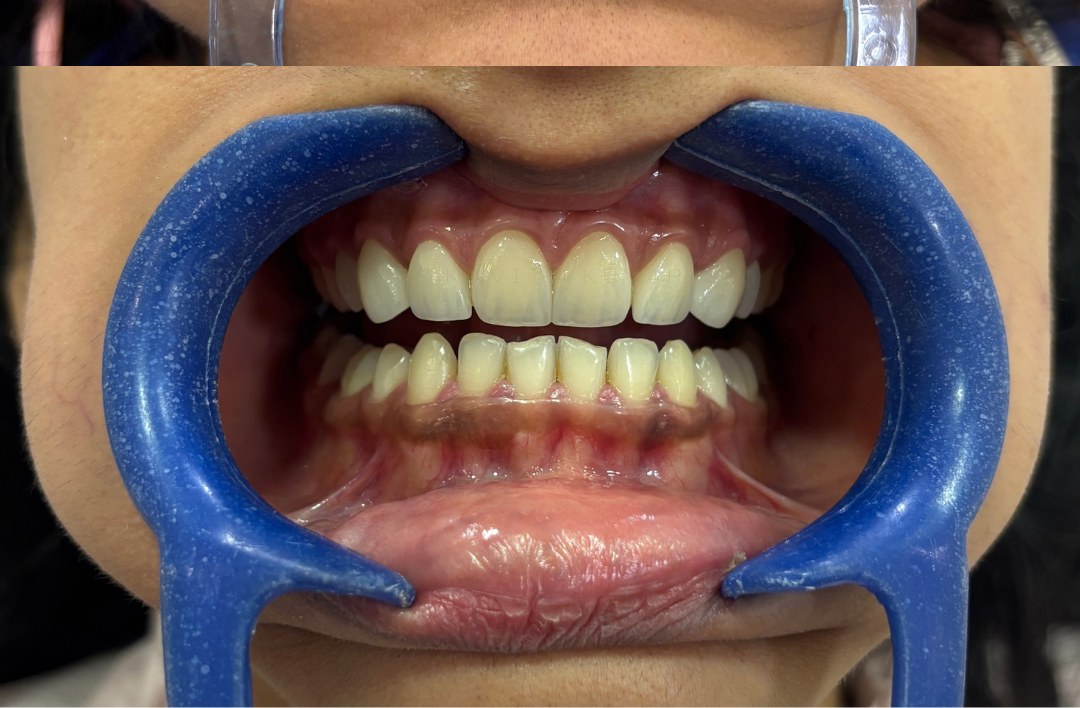 After treatment