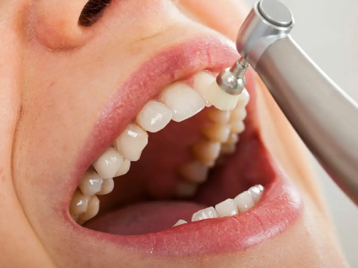 Cleaning — Preventive & General Dentistry
