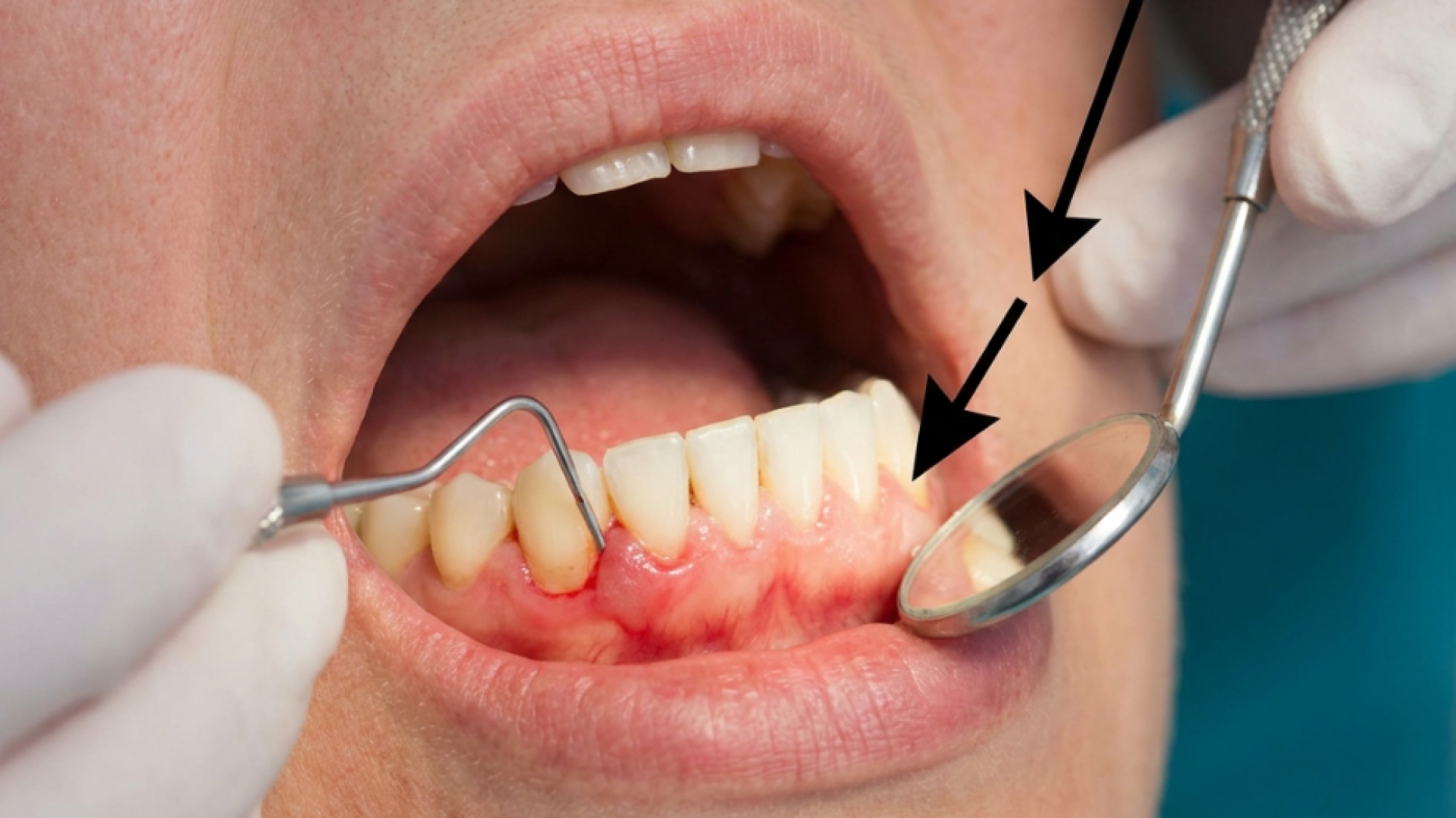 Gum Treatment — Preventive & General Dentistry