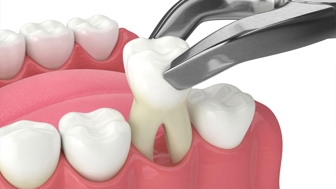 Extractions — Oral Surgery