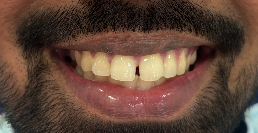 Before: Veneers