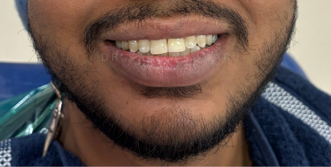 After: Anterior Zirconia Crowns