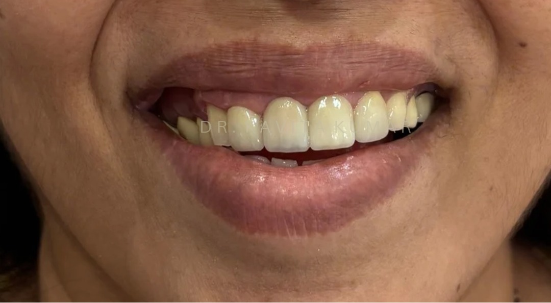 After: Upper Anterior Veneers