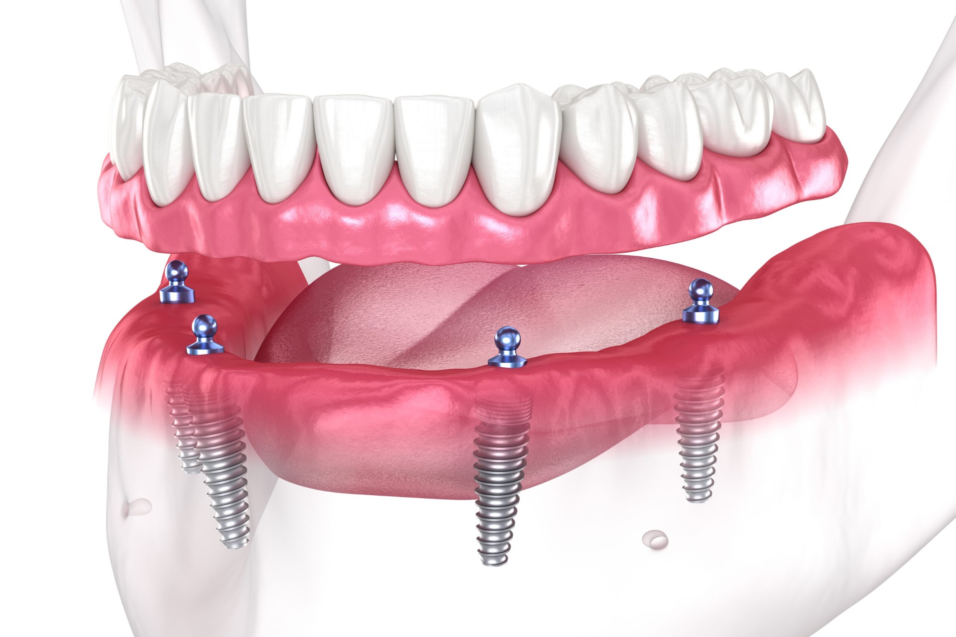 Full Mouth Rehabilitation — Restorative Dentistry