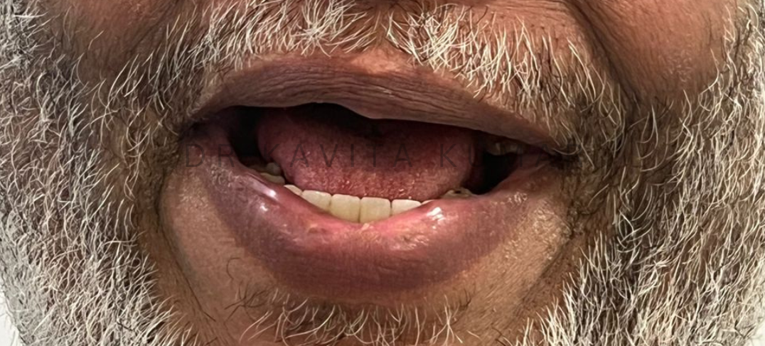 Before treatment