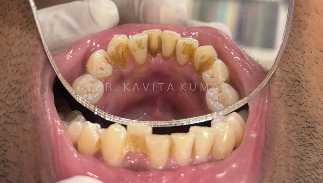 Before: Professional Teeth Cleaning