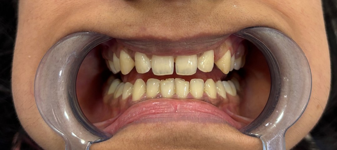 Before treatment
