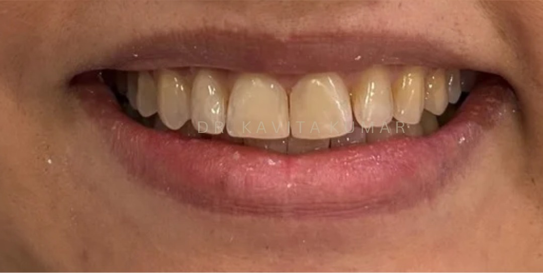After: Composite Bonding