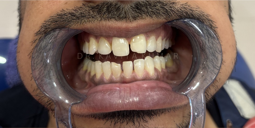 Before: Veneers