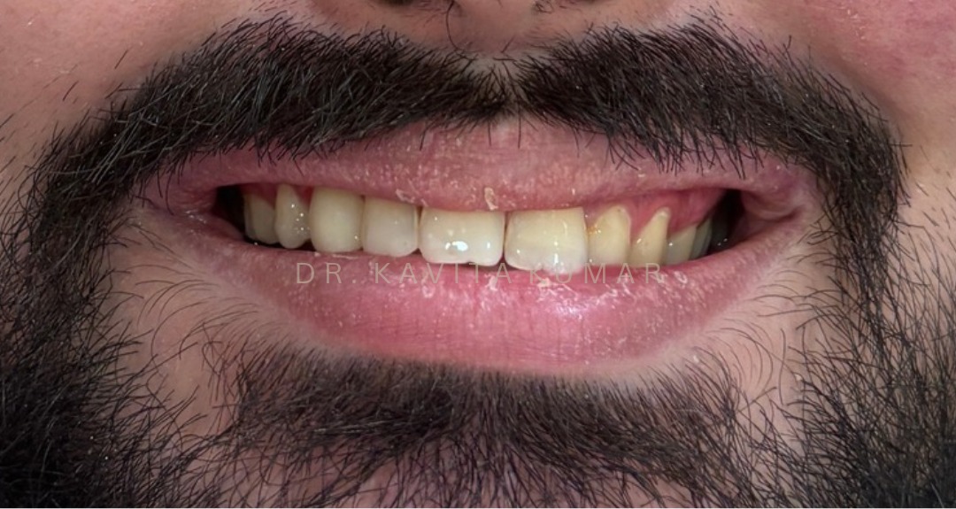 After: Composite Bonding