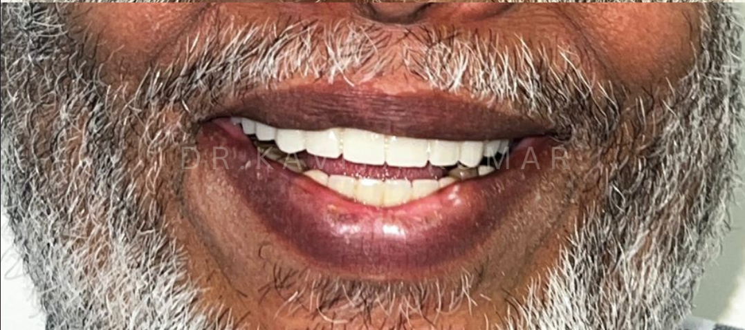 After treatment