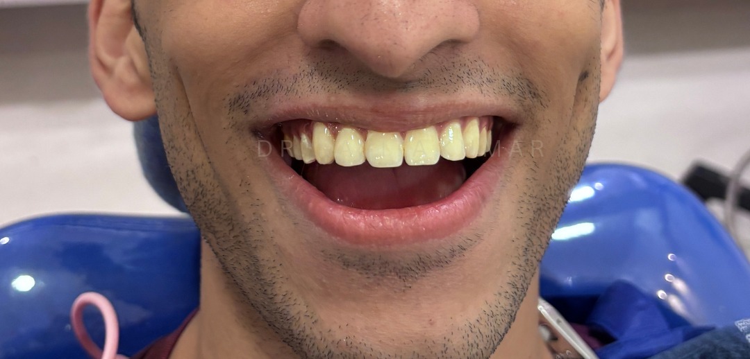 After: Composite Bonding