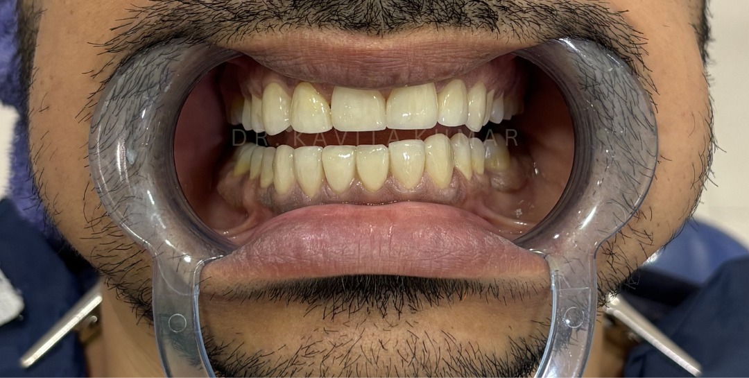 After: Veneers